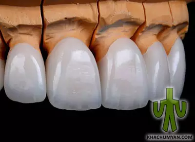 Ceramic crowns