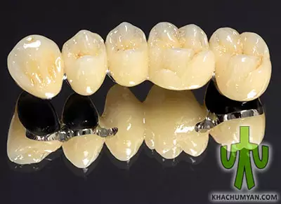 Metal-ceramic crowns