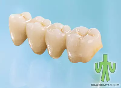 Plastic dental crowns