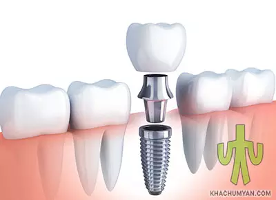 Parts of Dental Implant