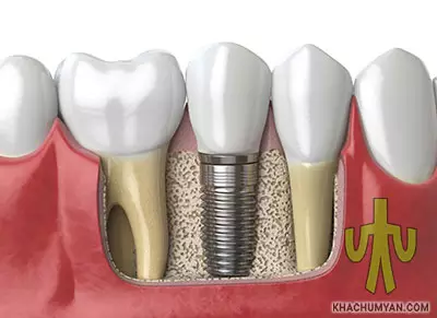 Dental Implants