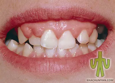 Hypertrophic Gingivitis