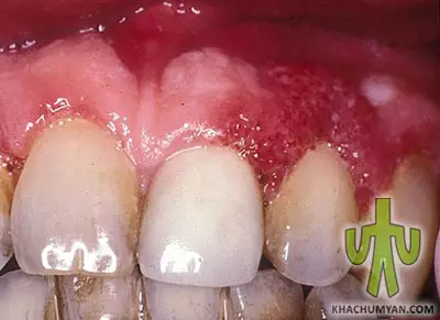 Acute Necrotizing Ulcerative Gingivitis (ANUG) 