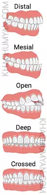 Malocclusion