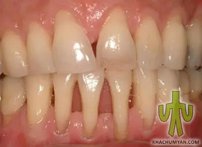 Periodontosis - gum disease