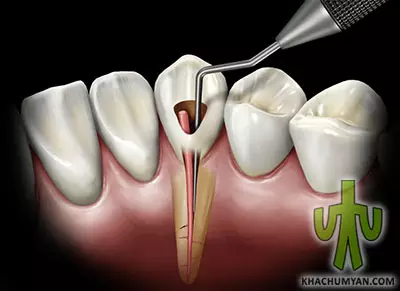 Treatment of periodontitis