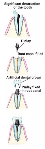 Pinlays