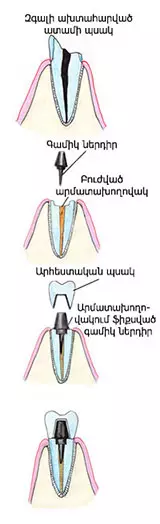 Գամիկ ներդիր