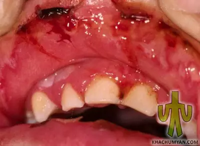 Ulcerative stomatitis (Vincent's stomatitis)