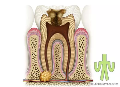 Causes of a dental cyst