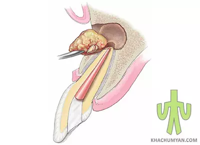 Treatment of a dental cyst