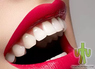 Hollywood smile - Veneers