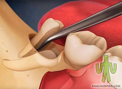 Incorrect placement of a wisdom tooth - removal